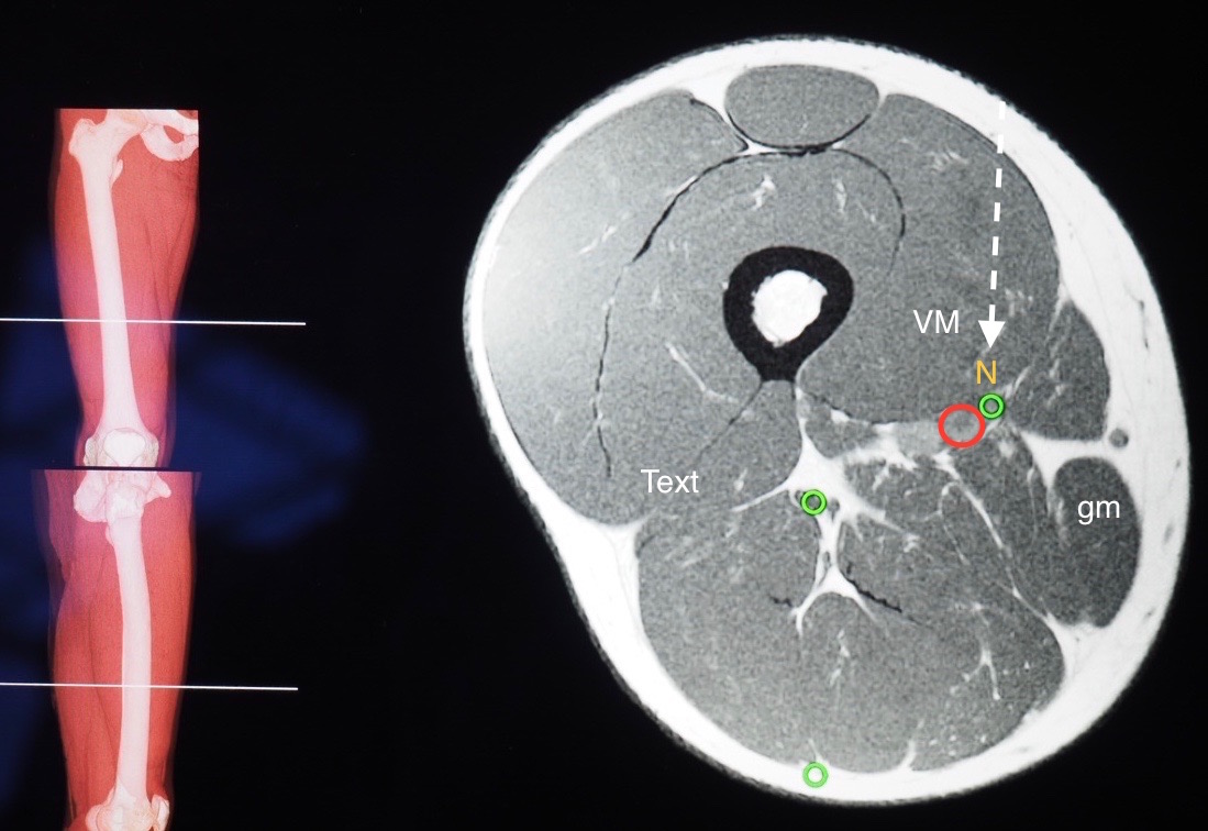 adductor canal