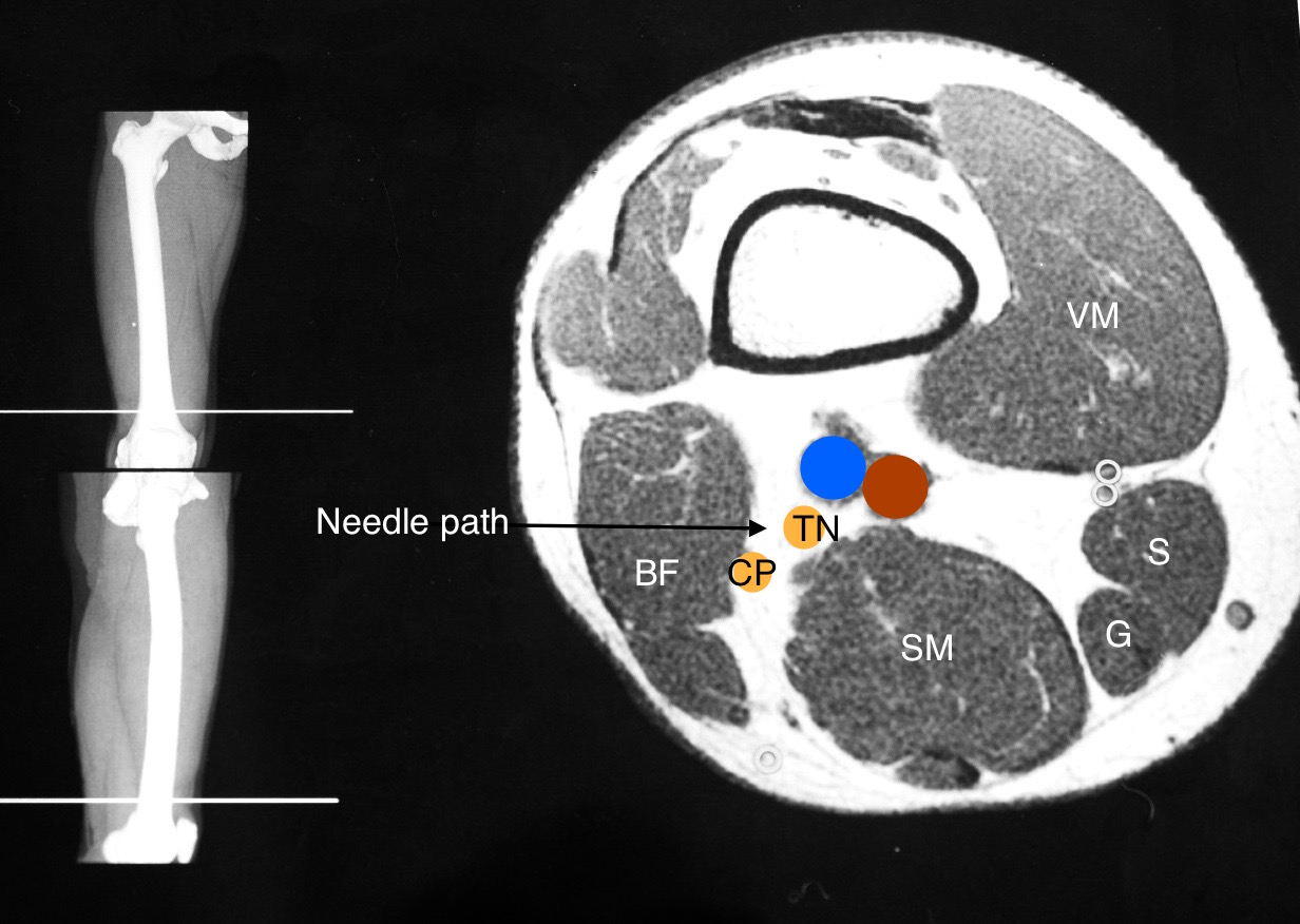 Bats Better Anaesthesia Through Sonography